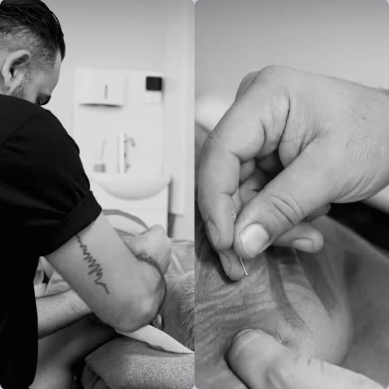 Dry needling