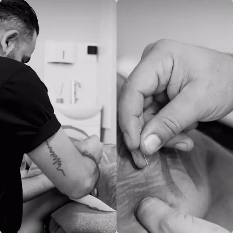Dry needling